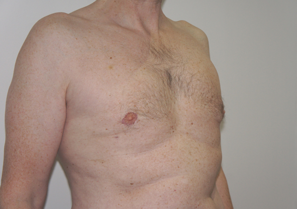 Breast Fat Transfer Before and After Image