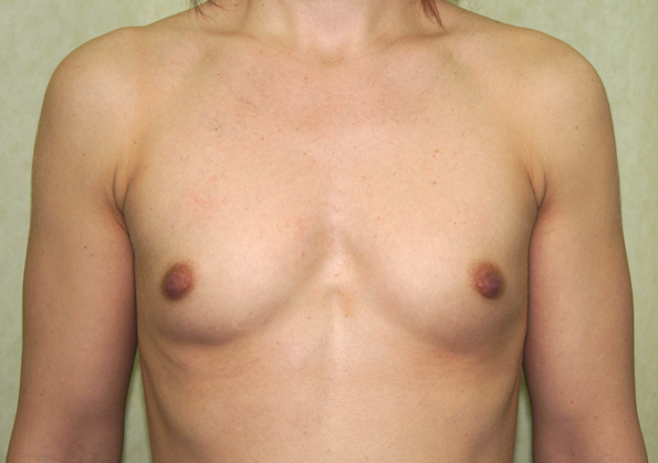 Breast Fat Transfer Before and After Picture